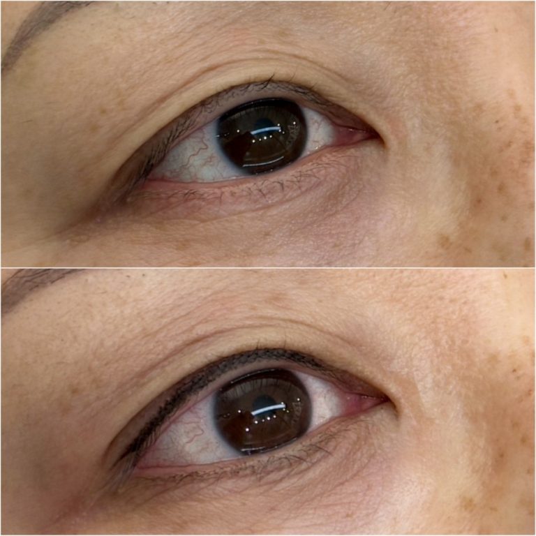 Close-up of a person's right eye shown in two images, with the lower image displaying smoother eyelid skin and more defined eyebrow compared to the upper image.