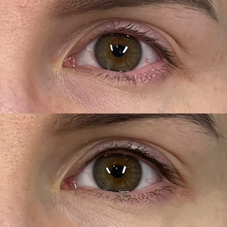 Close-up comparison of the same person's right eye, shown in two nearly identical images stacked vertically.
