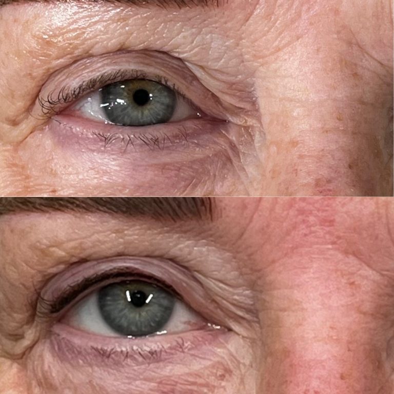 Close-up comparison of the skin around two blue-green eyes, showing visible wrinkles and texture differences in the undereye and crow’s feet areas.