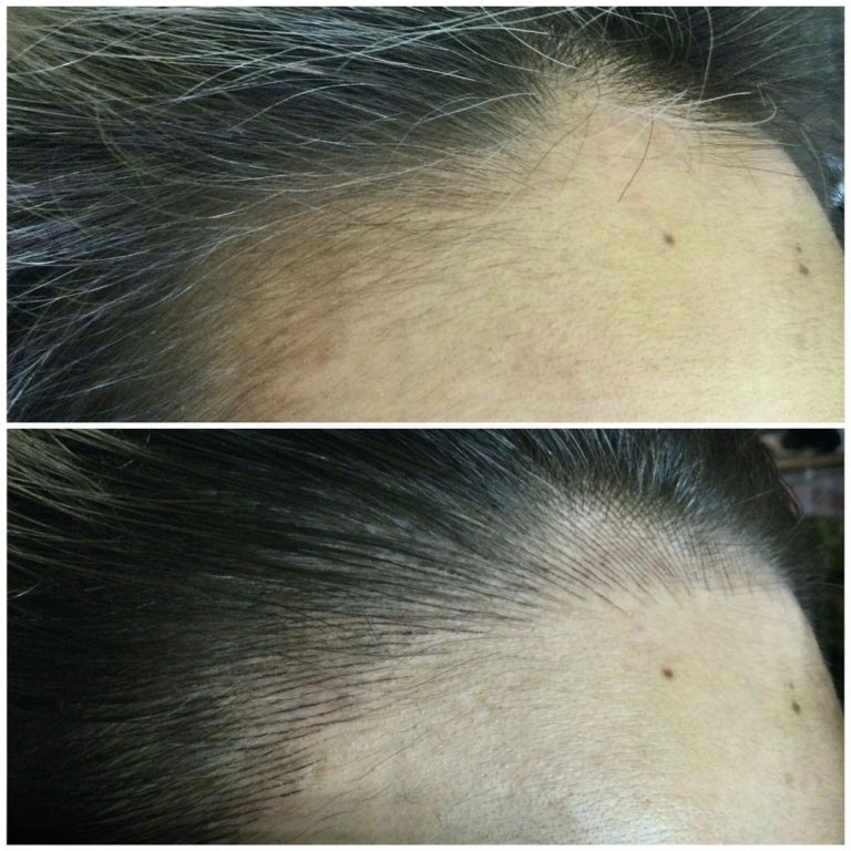 Side-by-side images show a person's hairline before (thinner hair) and after (denser hair growth), with a visible mole on the forehead in both images.