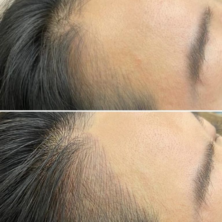 Two side-by-side close-up images of a person's hairline, showing increased hair density in the lower image compared to the upper image.