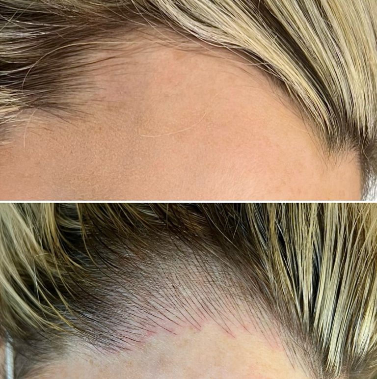 Top: Close-up of a person's hairline and forehead. Bottom: Same area after hairline microblading, showing small, fine strokes resembling hair growth.