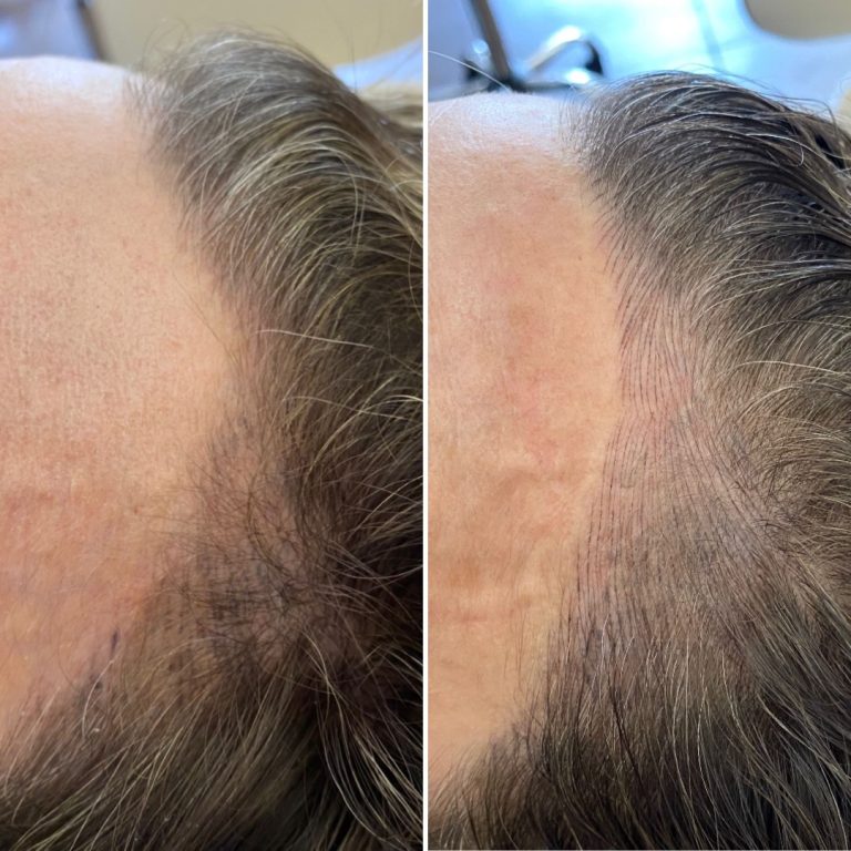 Side-by-side comparison of a hairline before and after treatment, showing increased hair density and improved hairline appearance on the right.