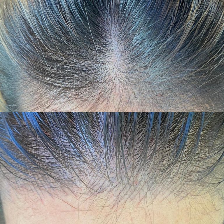Two close-up shots of a person's scalp showing part lines in their hair, with visible roots and some areas of thinning or sparse hair.