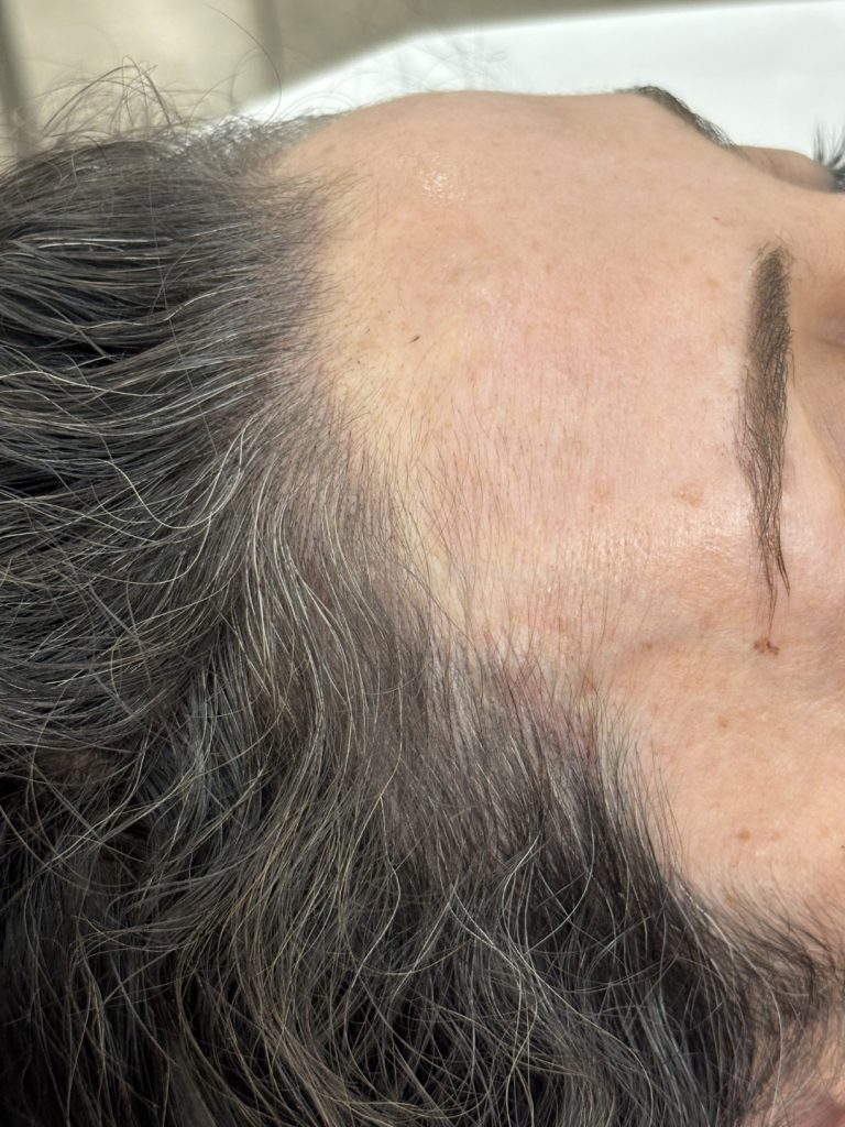 Close-up of a person's hairline showing thinning hair and some gray strands, with part of the forehead and eyebrow visible.