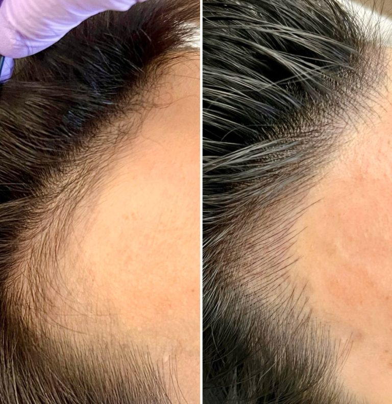 Side-by-side comparison showing a person's hairline before and after treatment, with increased hair density visible in the after image.