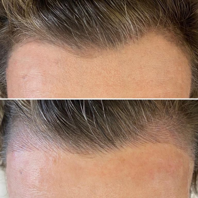 Close-up comparison of a hairline before (top) and after (bottom) a cosmetic procedure, showing increased hair density at the hairline in the after image.