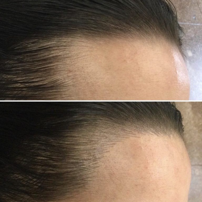 Two side-by-side images show a person's hairline before and after treatment; the lower image displays a visibly fuller and more defined hairline.