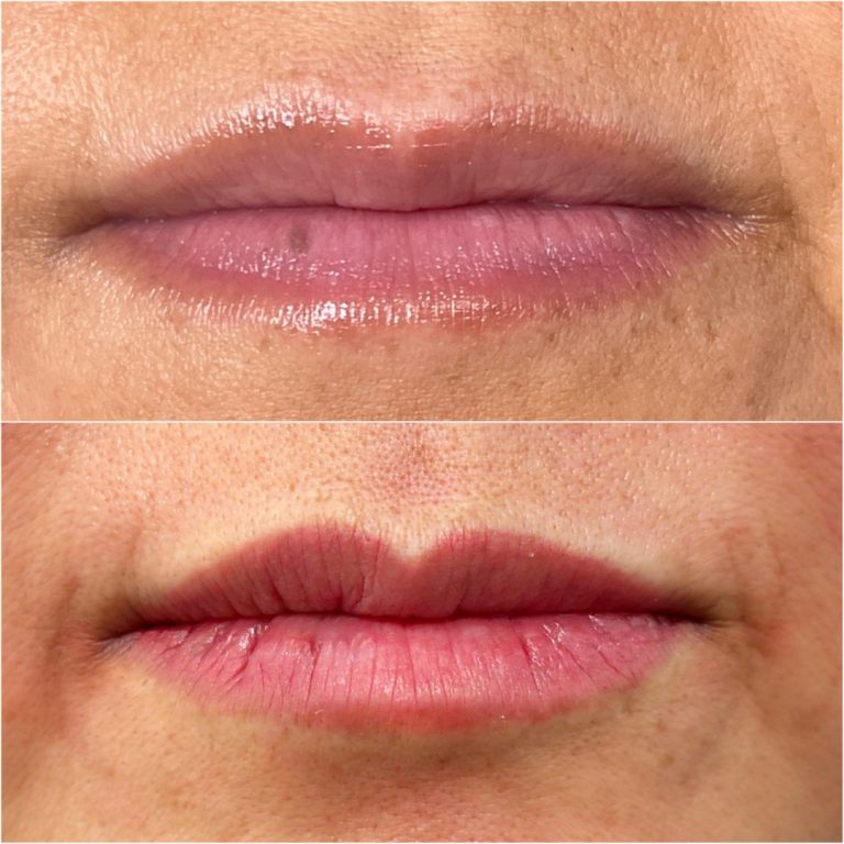 Close-up comparison of lips before (top) and after (bottom) a cosmetic procedure, showing changes in color, shape, and definition.