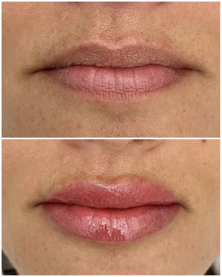Close-up of lips before and after a cosmetic treatment; the top image shows natural lips, and the bottom shows fuller, glossier lips.