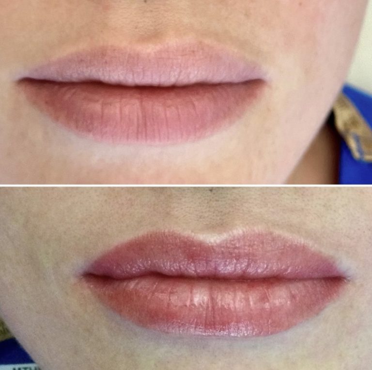 Two close-up images of lips: the top shows natural lips; the bottom shows the same lips with enhanced shape and color, likely after a cosmetic procedure.