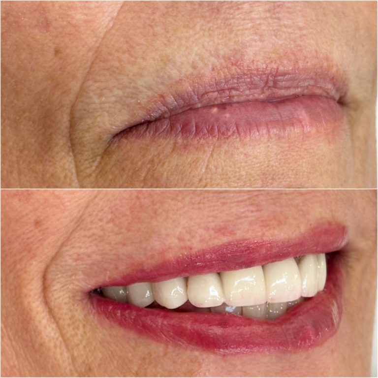 Close-up before-and-after photos showing lips: the top image displays closed, natural lips; the bottom image shows lips with visible teeth and applied makeup or cosmetic enhancement.