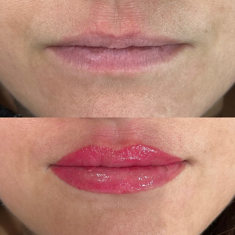 Close-up of lips before (top, natural color) and after (bottom, enhanced with pink gloss) a cosmetic lip treatment.