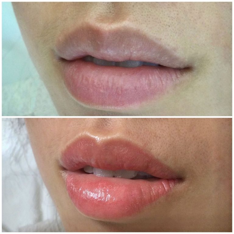 Close-up of lips showing a before and after comparison; the bottom image shows fuller, glossier lips than the top image.