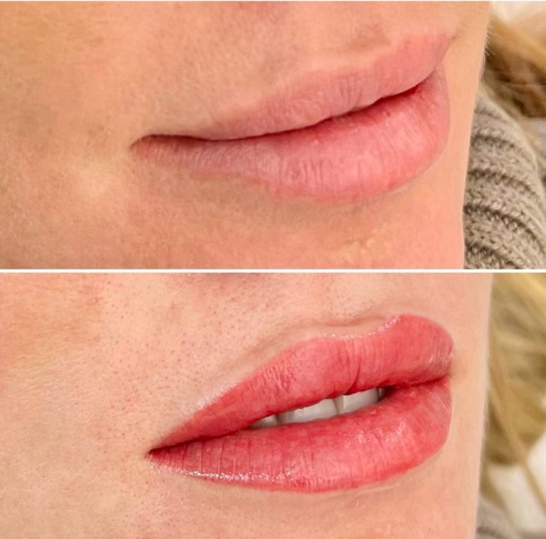 Close-up of lips before and after a cosmetic procedure; the top image shows natural lips, while the bottom image shows fuller, more defined, and glossy lips.