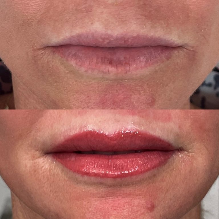 Close-up of lips showing a before (top) and after (bottom) comparison; the bottom image features fuller, well-defined, and glossy lips.