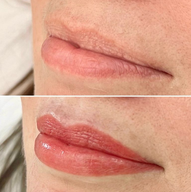 Close-up of lips before and after a cosmetic procedure; the top image shows natural lips, and the bottom image shows fuller, more defined lips with enhanced color.
