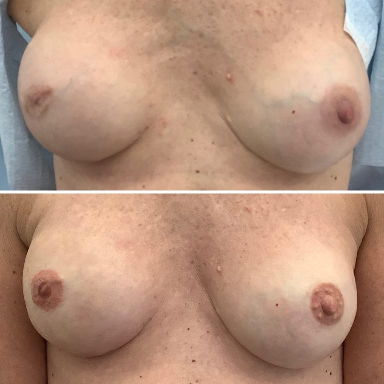 Two side-by-side photos show a person's chest before (top) and after (bottom) breast reconstruction surgery, with differences in shape, size, and nipple appearance.