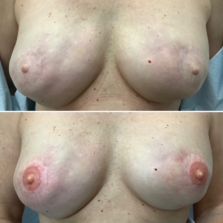 Top: Breasts with scars and uneven areolas. Bottom: Same breasts after nipple and areola reconstruction, showing improved symmetry and pigmentation.