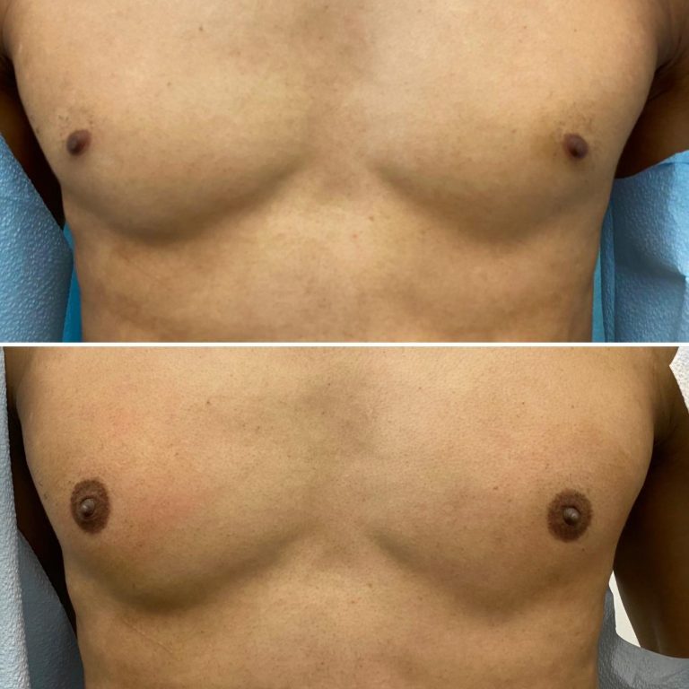 Two side-by-side photos show a person's bare chest before (top) and after (bottom) a procedure affecting the appearance of the nipples and areolas.