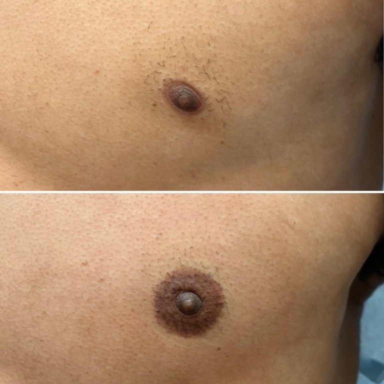 Close-up comparison of a person's chest, showing the nipple and areola before (top) and after (bottom) what appears to be a cosmetic procedure or pigmentation change.