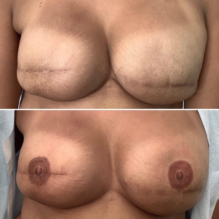 Before and after comparison of breast reconstruction, showing the addition of areola and nipple tattooing in the lower image.