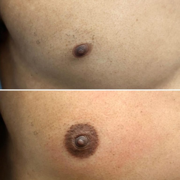 Close-up of a person's chest showing a lighter areola in the top image and a darker, more defined areola in the bottom image, suggesting a cosmetic change.