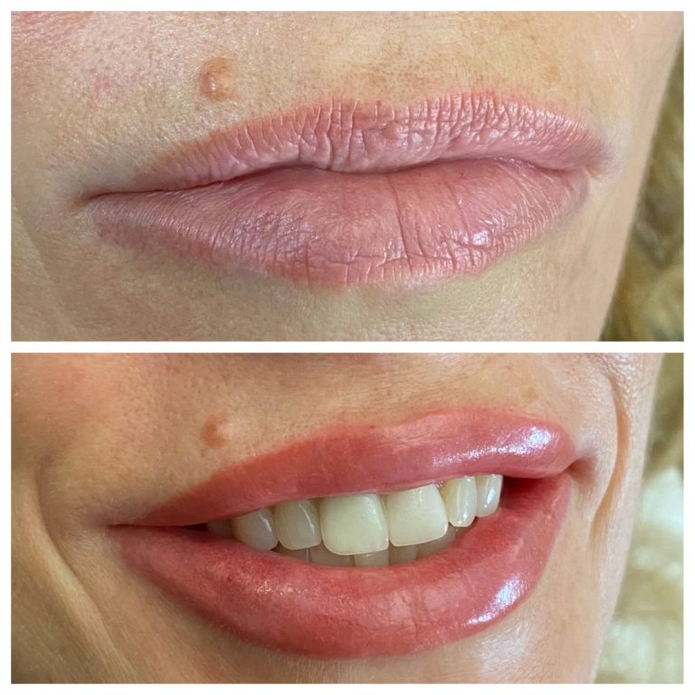 Two close-up photos show lips before and after a cosmetic procedure; the top image has bare lips, the bottom shows fuller, glossier lips with visible teeth.