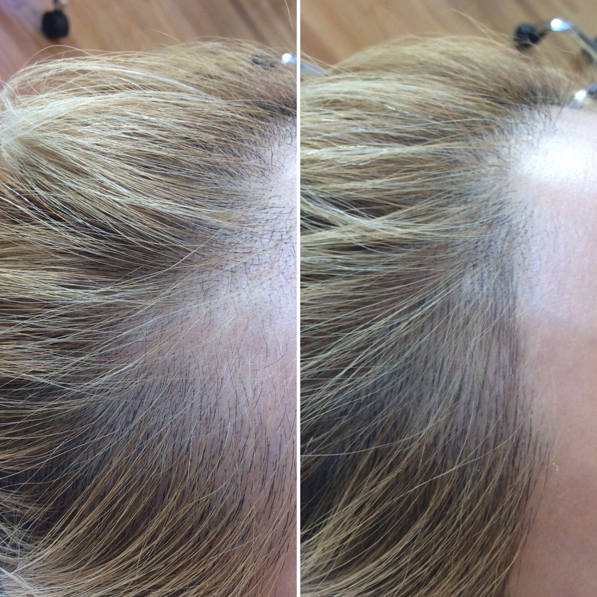 Close-up of a person's scalp showing a before-and-after comparison of hair density improvement along the hairline.