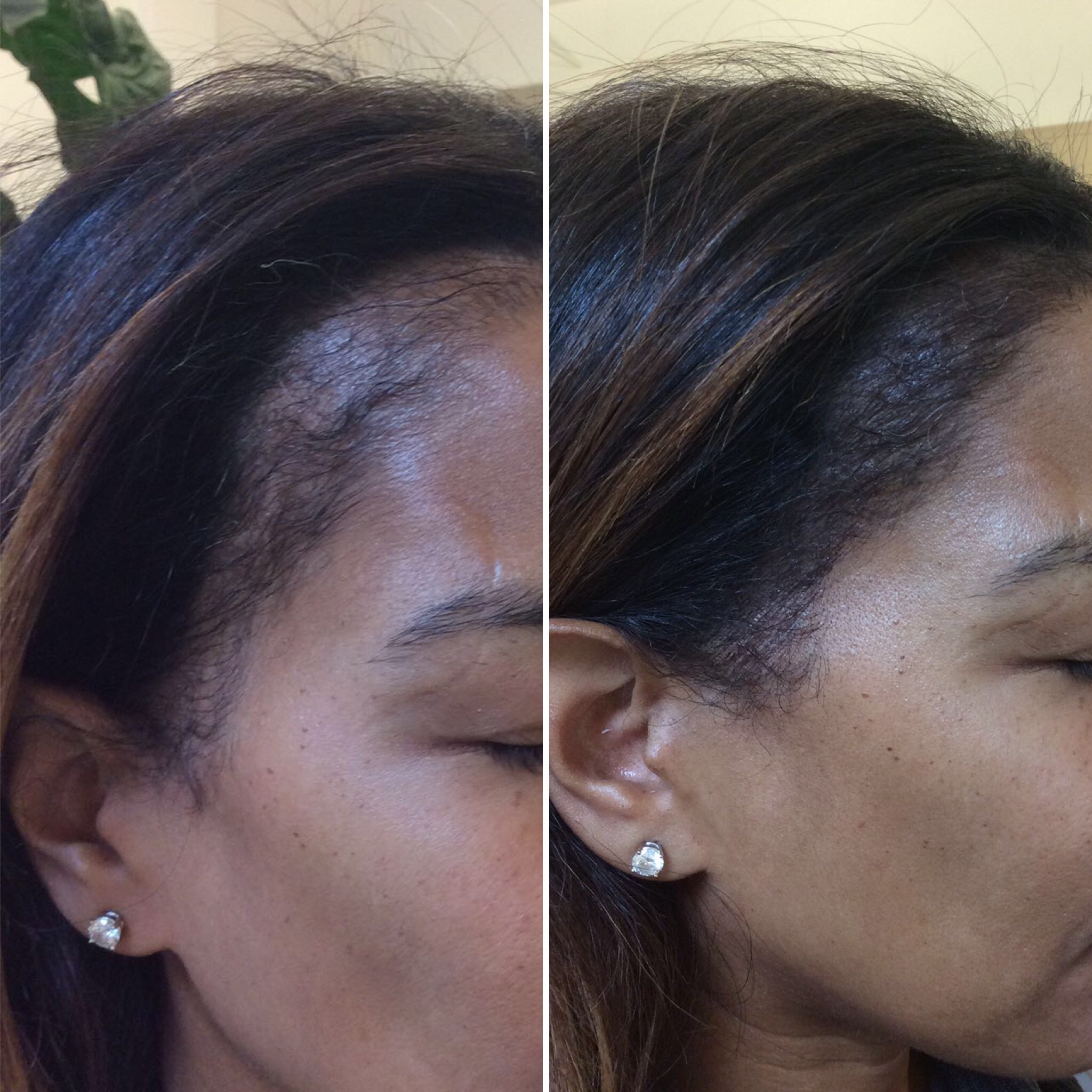 Side-by-side comparison of a woman's hairline before and after treatment, showing noticeable hair regrowth and fuller edges on the right.