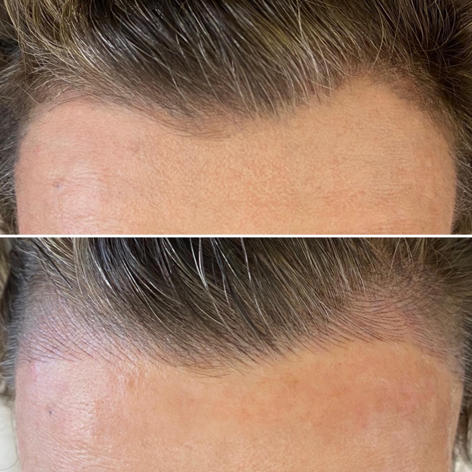 Two close-up images of a person's hairline; the top shows a receding hairline, while the bottom shows a fuller, restored hairline after treatment.