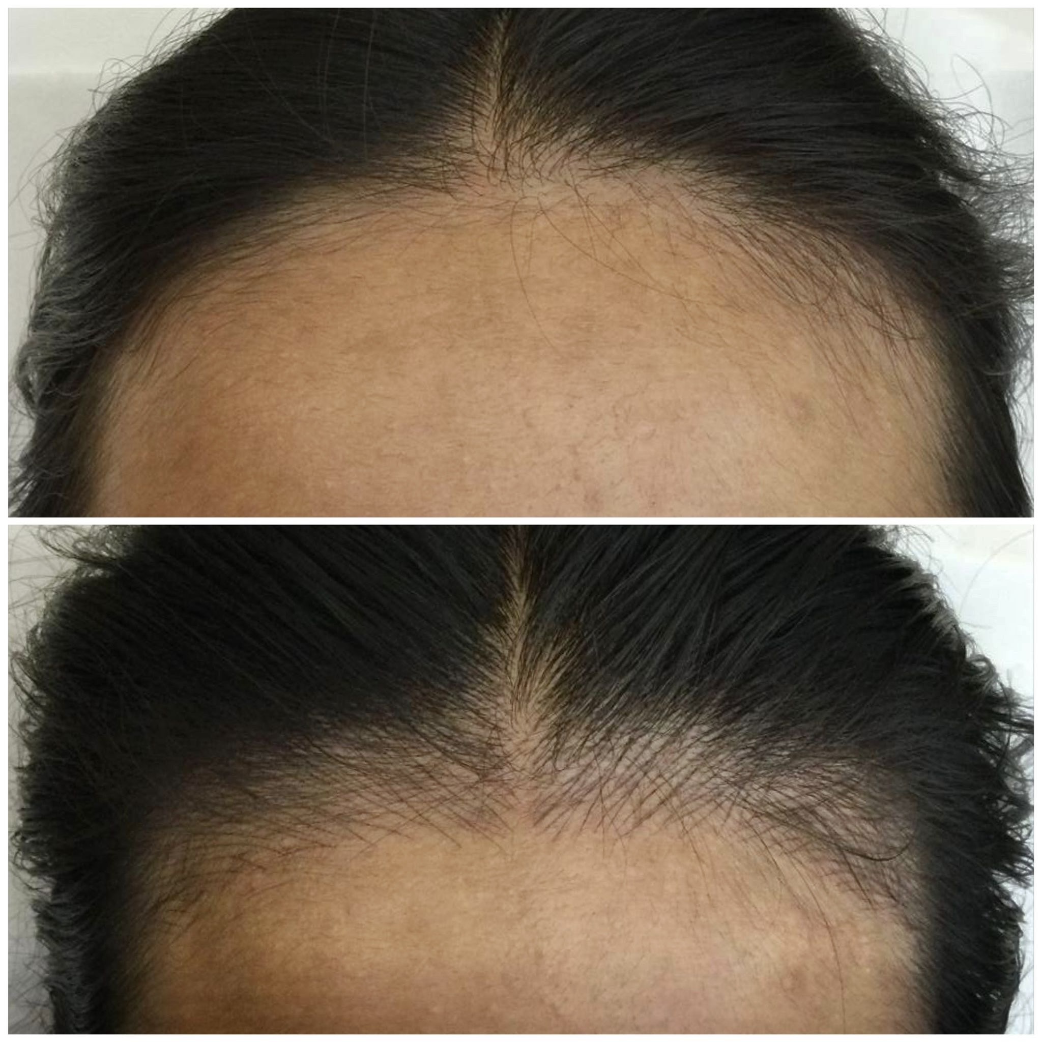 Two side-by-side images showing a person's hairline before (top) and after (bottom) a visible increase in hair density and regrowth.