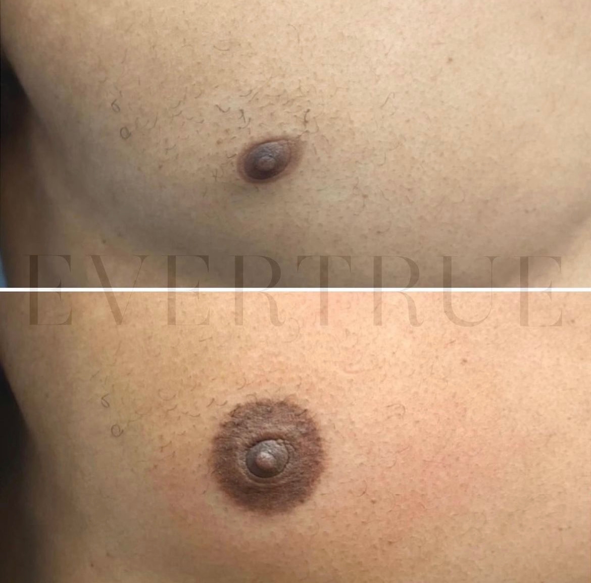 Two side-by-side images showing a chest before and after a cosmetic procedure, with the lower image displaying a darker, more defined areola around the nipple.