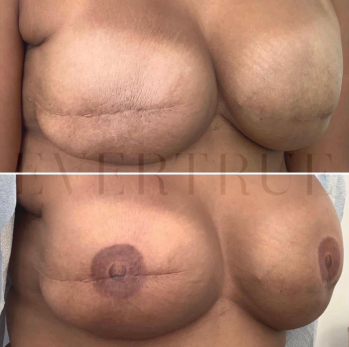 Two side-by-side images show a person's chest before and after breast reconstruction surgery with areola tattooing. Scars and skin color differences are visible in both images.