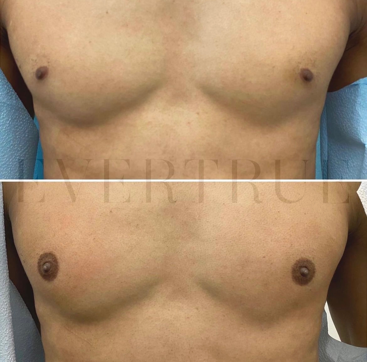 Side-by-side comparison of a male chest before (top) and after (bottom) a cosmetic procedure, showing changes in contour and nipple appearance.