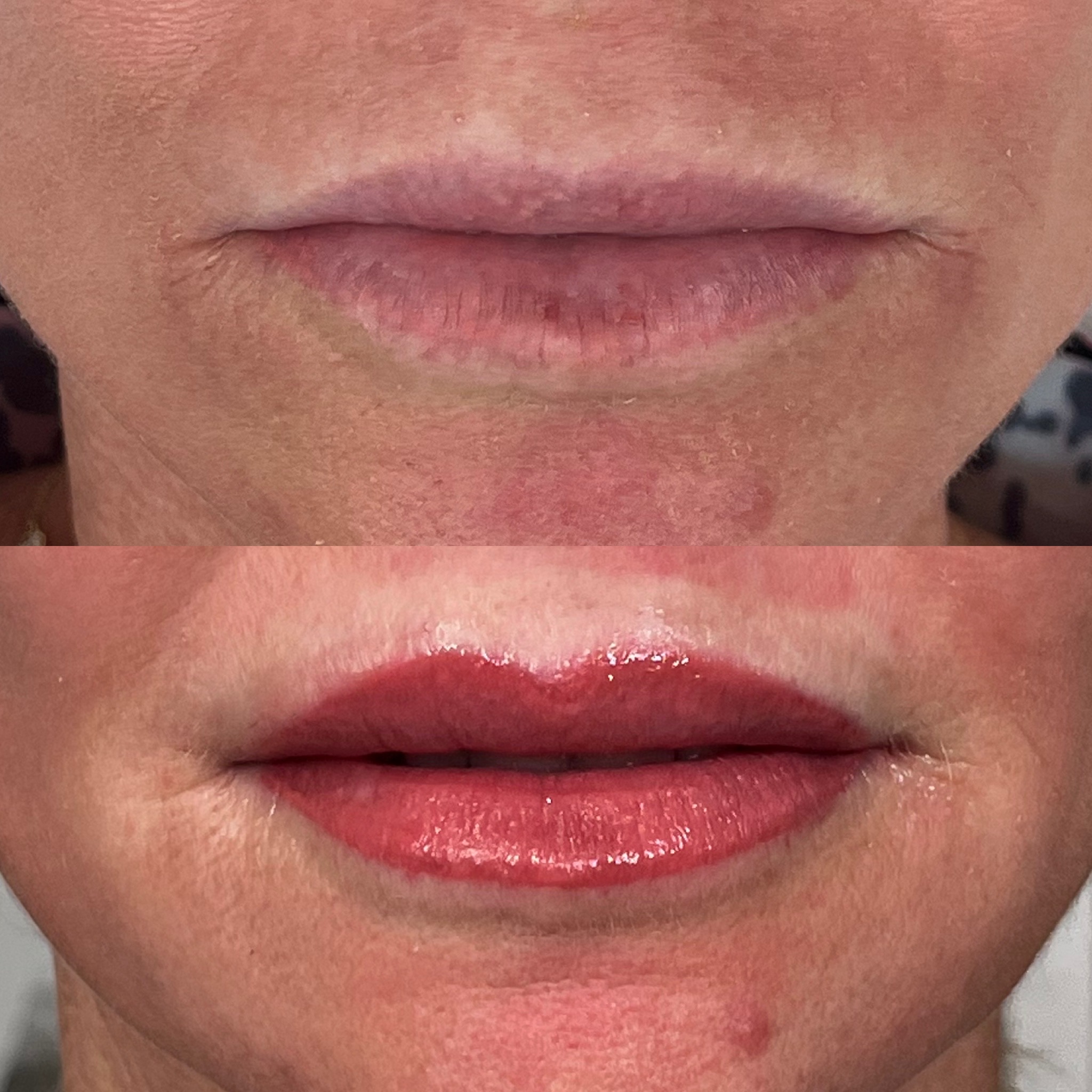 Close-up of lips before and after a cosmetic procedure; the top image shows pale, dry lips, while the bottom image shows fuller, glossy, and more defined lips.