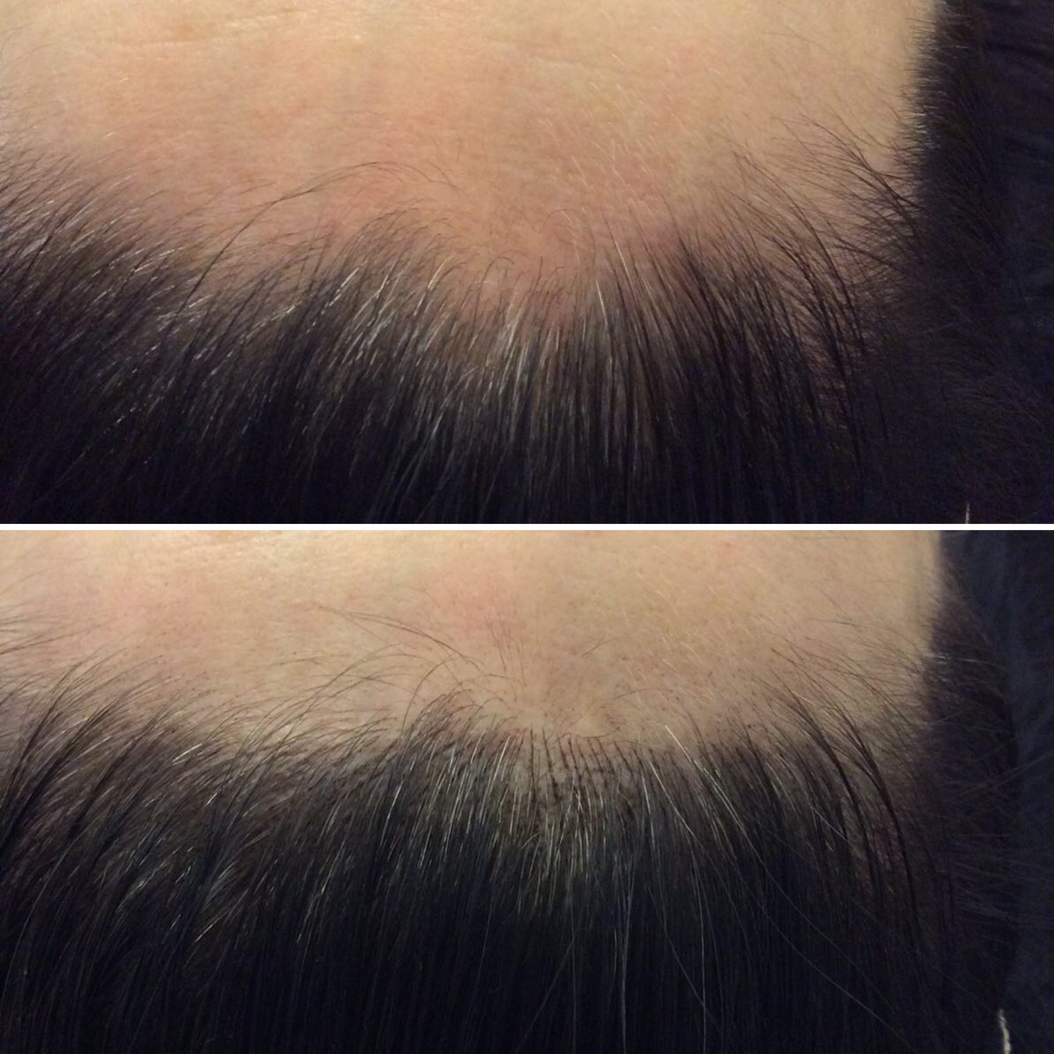 Two close-up images of a person's hairline; the top shows thinning hair and the bottom shows a fuller hairline with new hair growth.