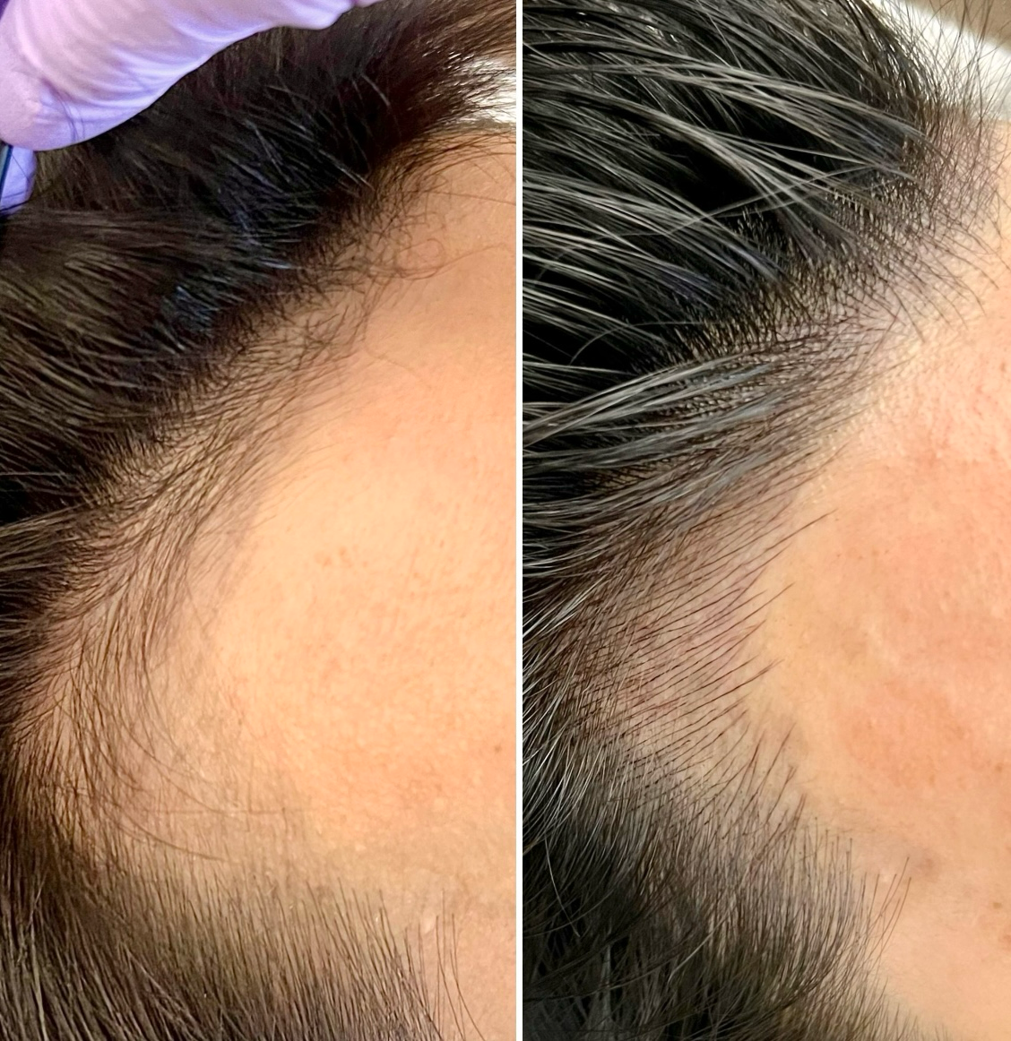 Close-up before and after images showing improved hair growth along a person's hairline.