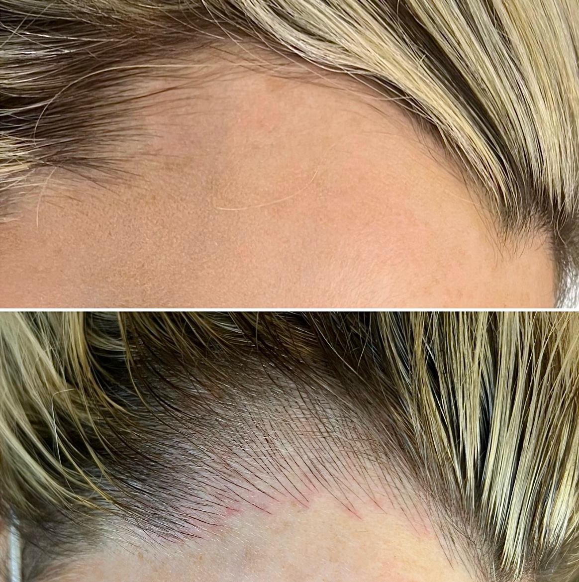 Close-up of a person's hairline before and after a cosmetic hair procedure, showing denser hair growth in the after image.