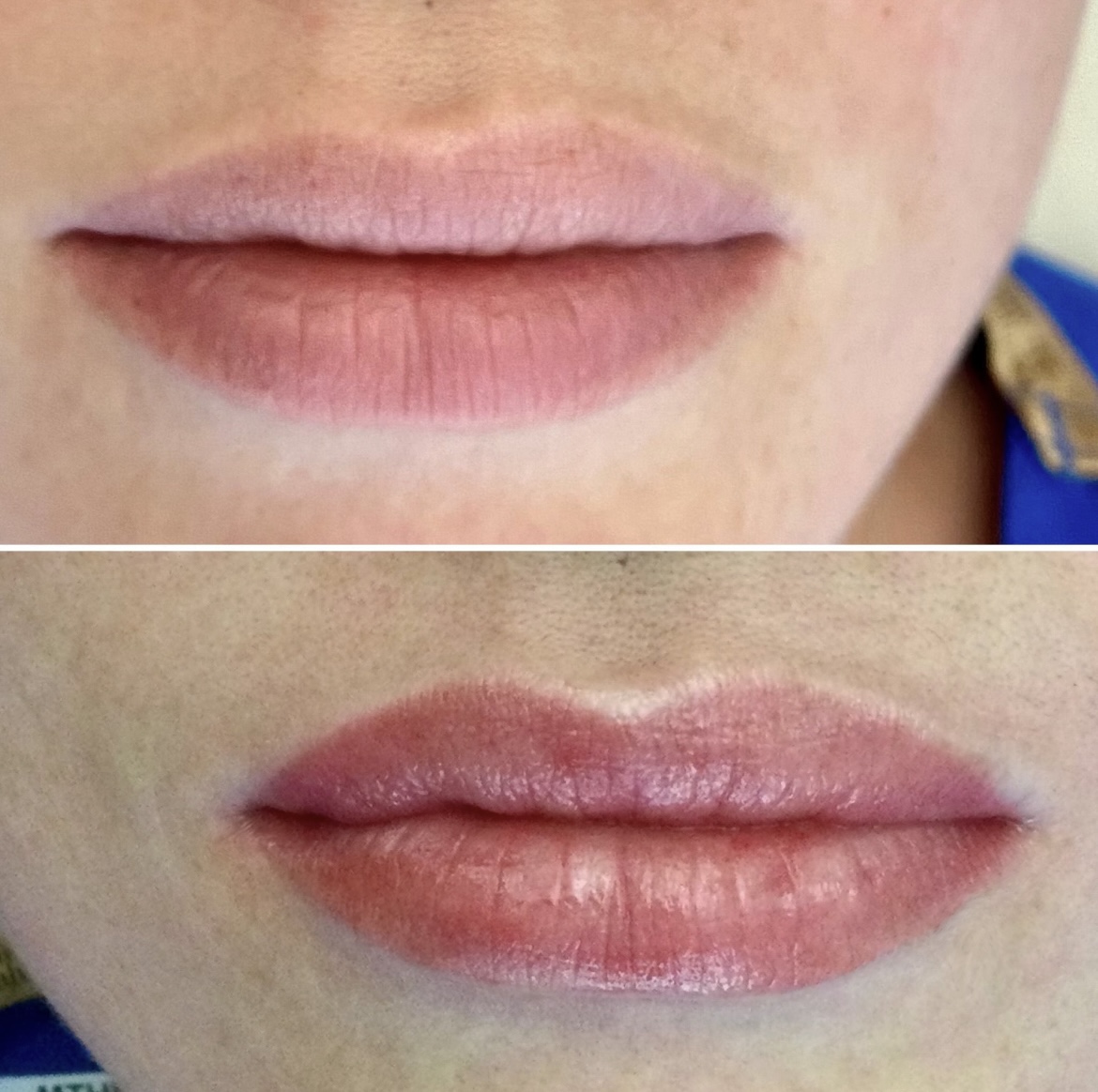 A close-up comparison of lips before and after a cosmetic procedure; the top image shows natural lips, and the bottom shows fuller, glossier lips.