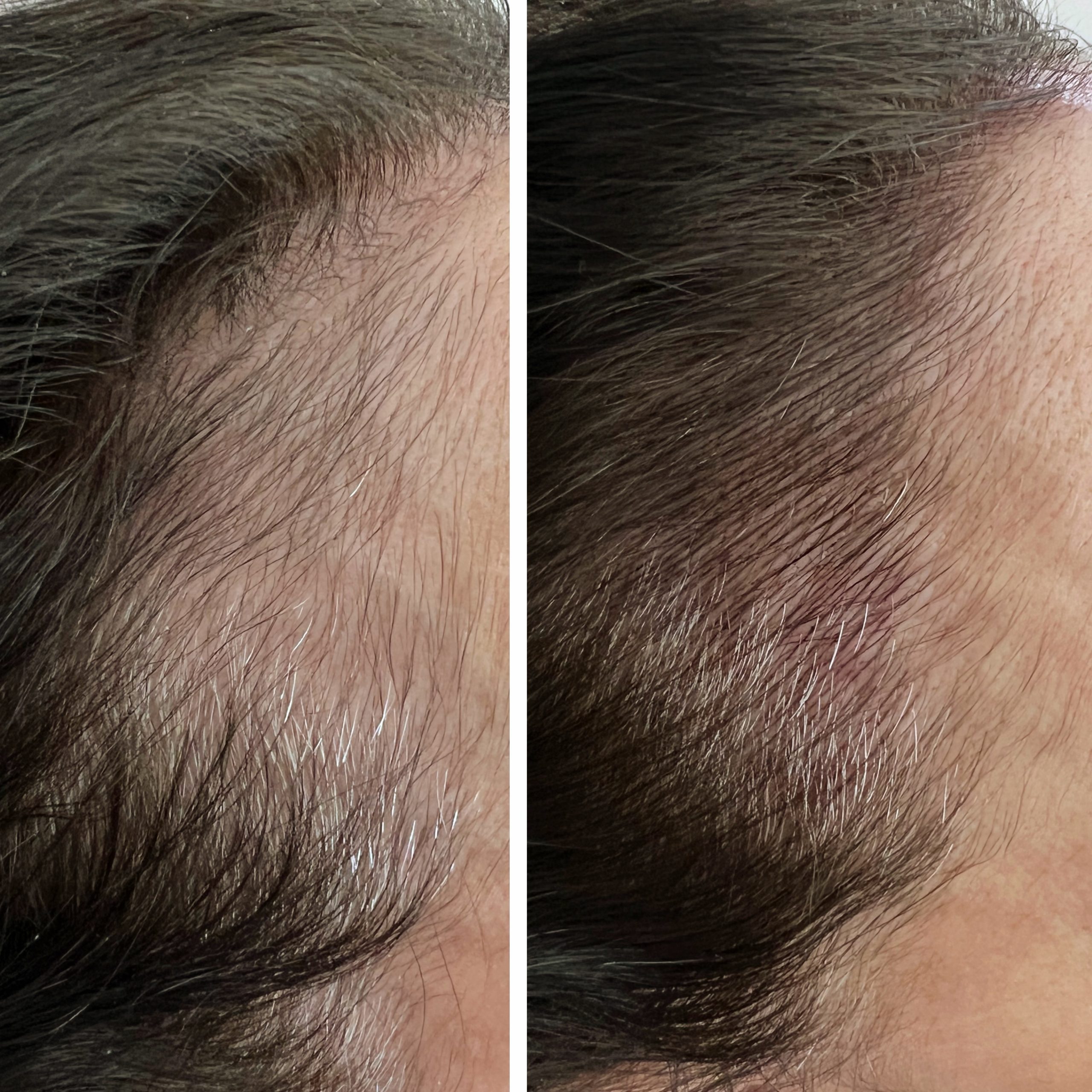 Side-by-side comparison of a person's hairline before and after treatment, showing increased hair density and coverage on the right.