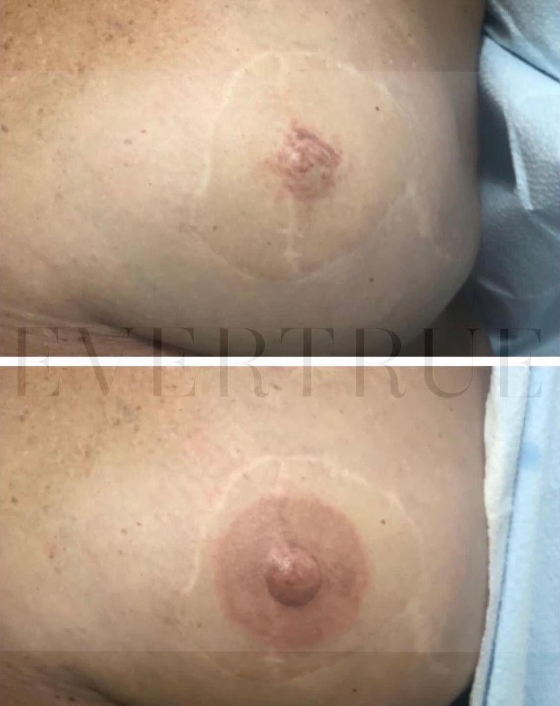 Before and after image showing a breast with a faded areola and nipple, followed by the same area after areola and nipple tattoo restoration.