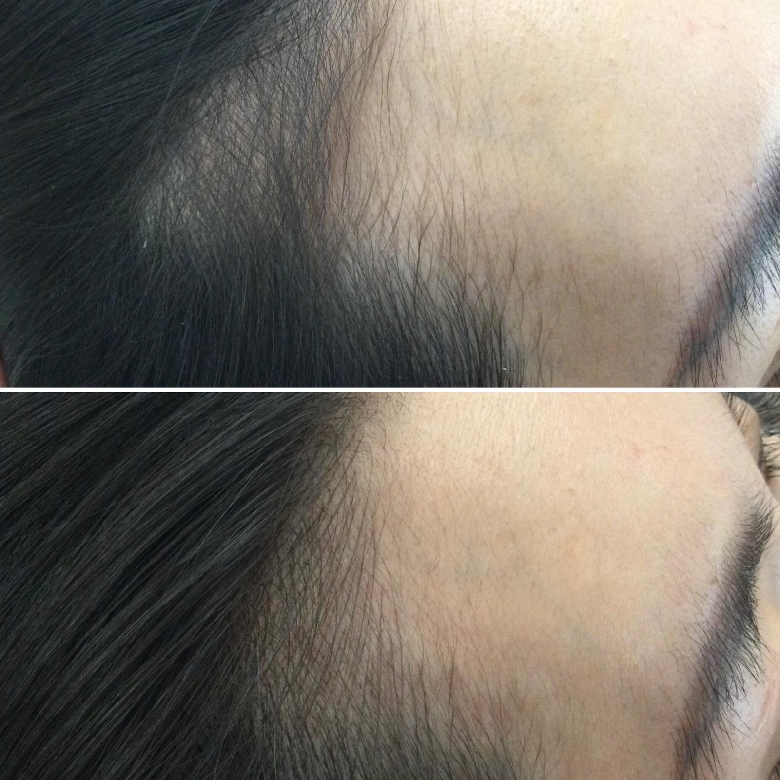 Two side-by-side photos of a person's hairline; the top shows thinning hair, while the bottom shows visibly fuller hair in the same area.