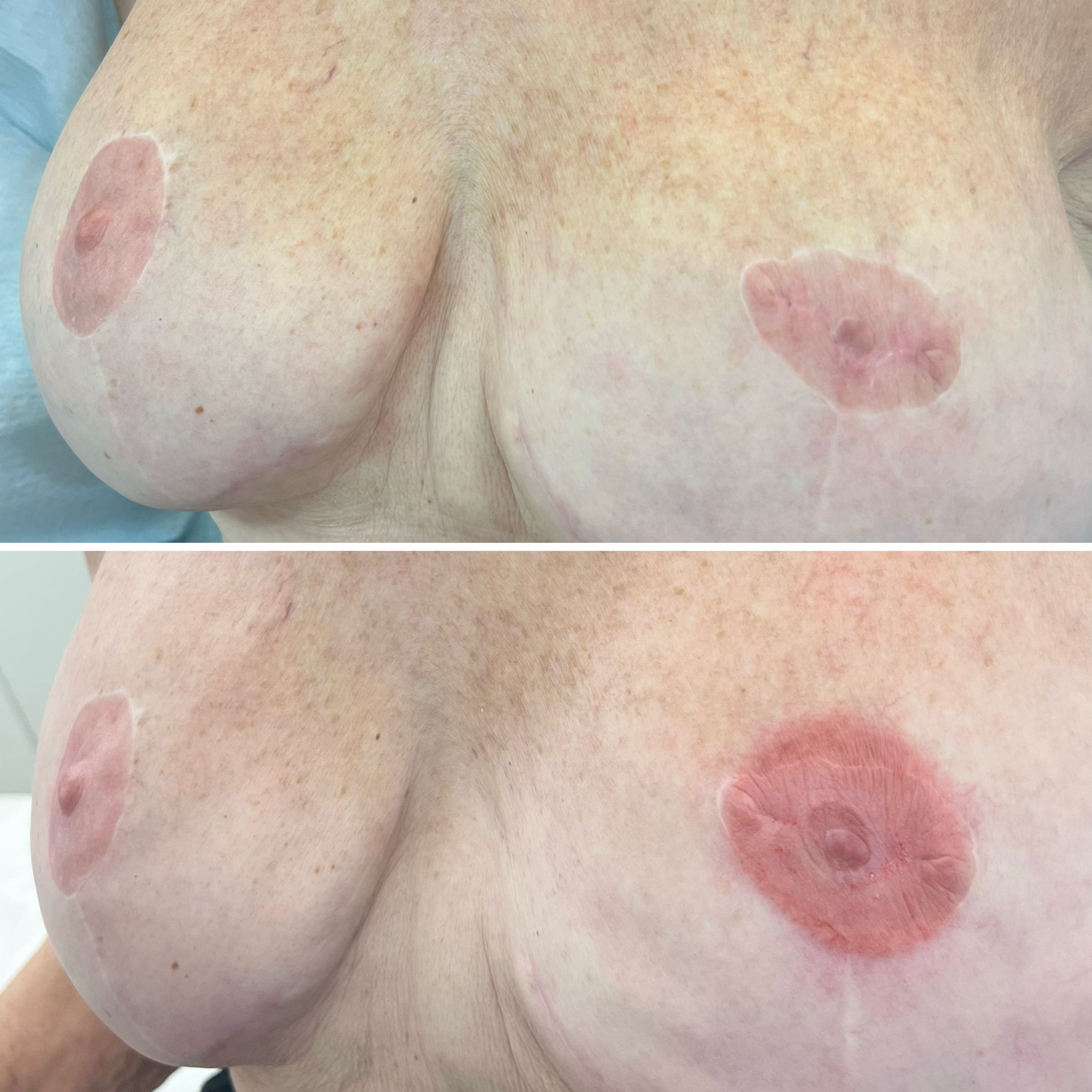 Two close-up images showing breasts with pale, circular scars around the areolas, suggesting post-surgical healing, possibly after reconstructive or cosmetic surgery.