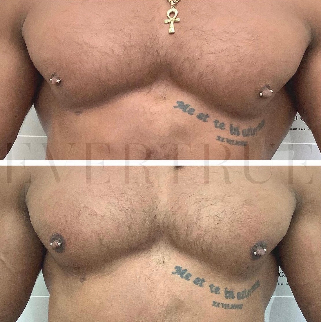 Two side-by-side photos show a person's chest before and after a procedure, with visible tattoos and nipple piercings in both images.