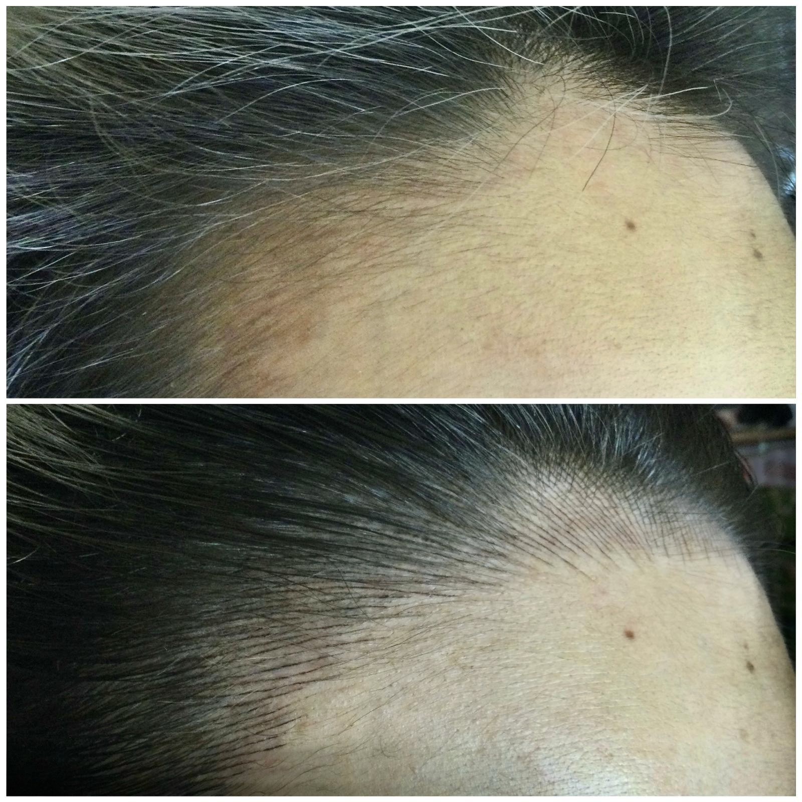 Two side-by-side photos show a person's hairline before and after a hair transplant procedure, with the after image displaying denser, newly transplanted hair.
