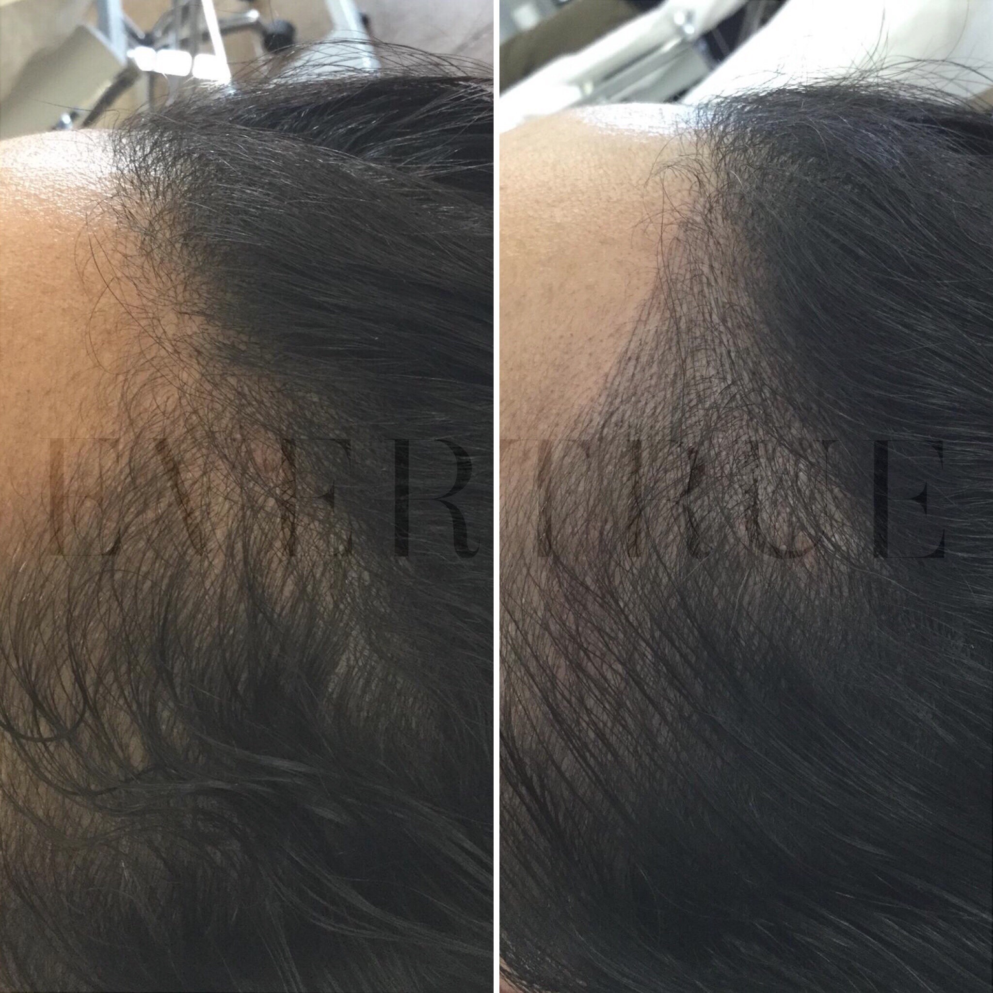 Side-by-side comparison of a person's hairline before and after treatment, showing fuller hair growth in the after image on the right.