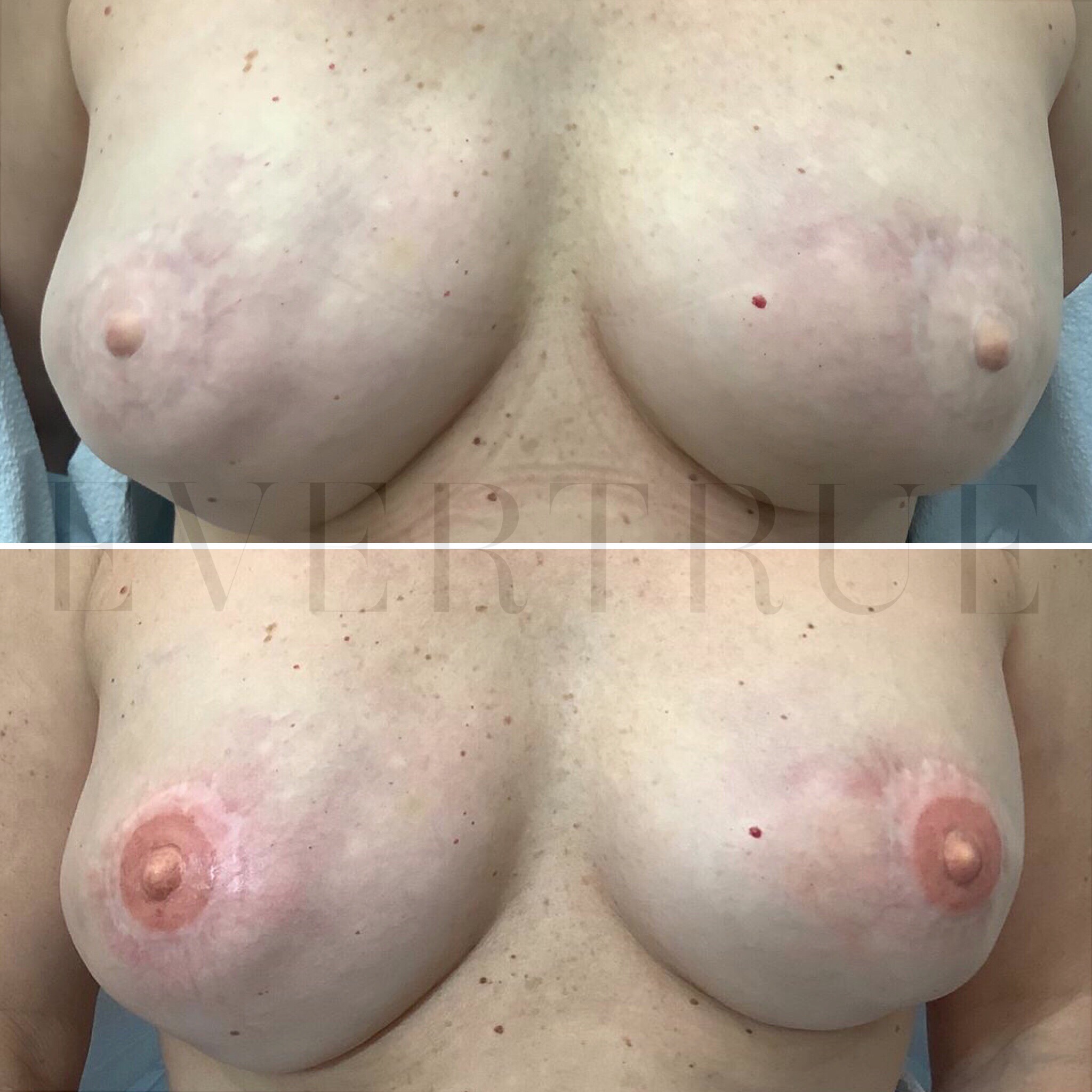 Two close-up, side-by-side images showing a person's chest before (top) and after (bottom) breast reconstruction or cosmetic surgery.