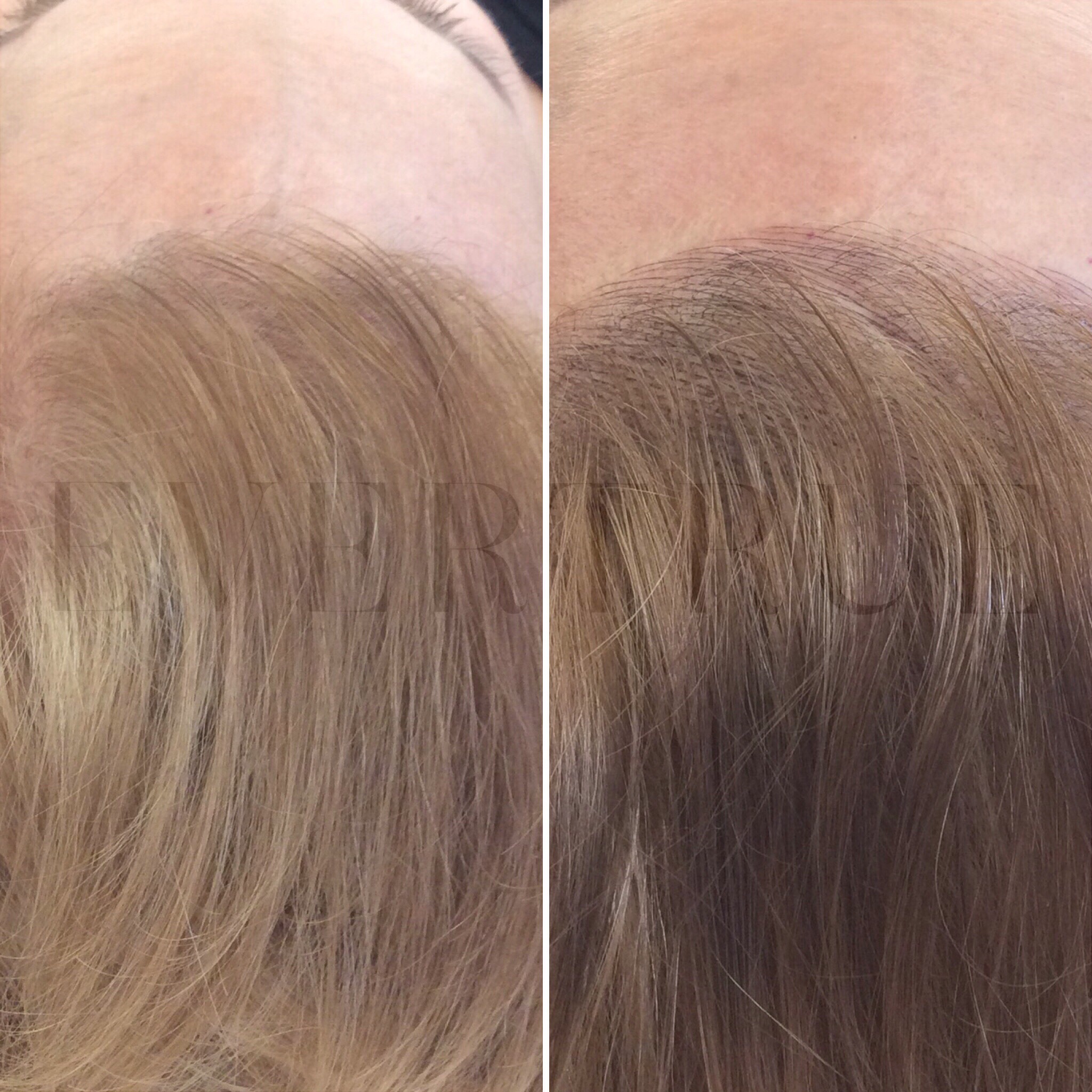 Side-by-side comparison of a person's scalp showing thinning hair on the left and fuller, thicker hair on the right.