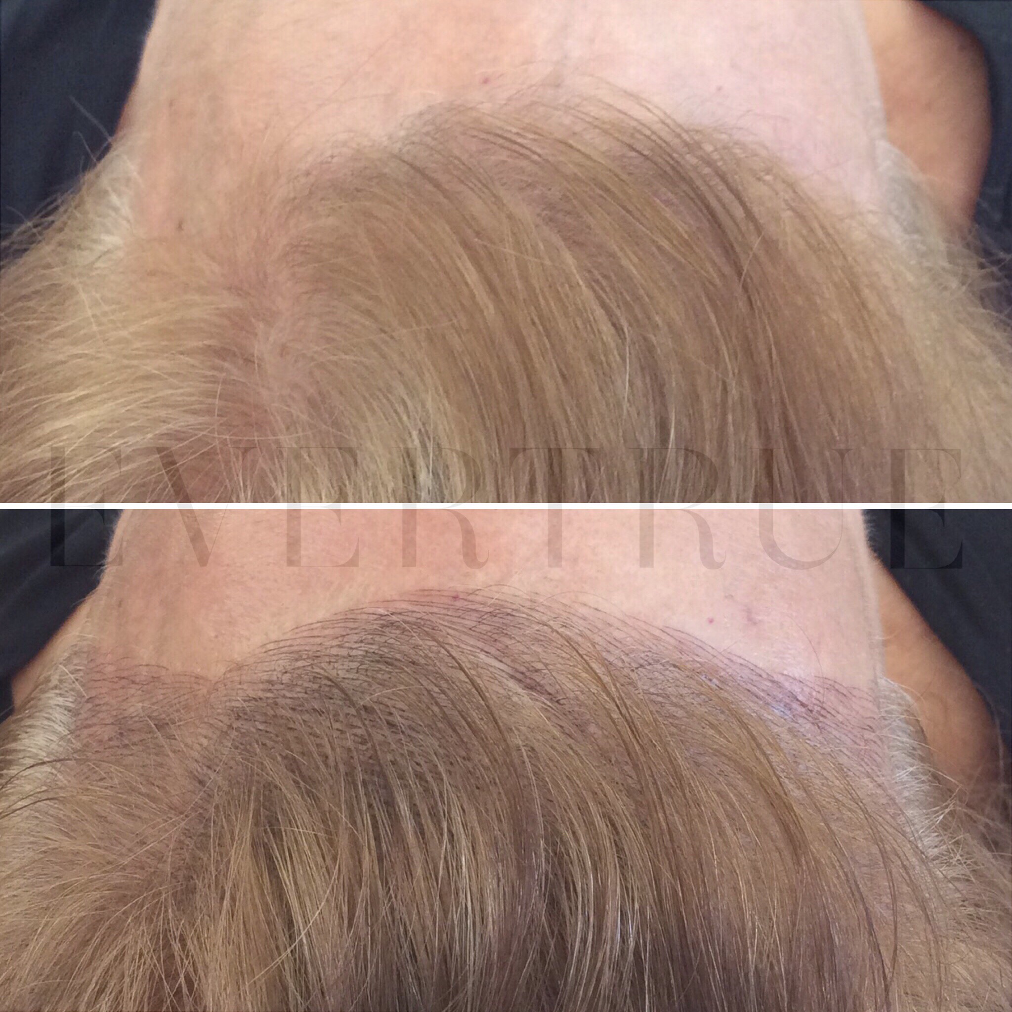 Close-up of the top of a person's scalp shown in two images; the top shows thinning hair, while the bottom shows fuller hair coverage.